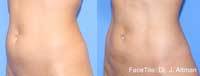 Abdomen Contraction before and after images